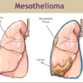 Mezotelyoma (Akciğer Zarı Kanseri) Nedir?