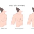 Pectus (Göğüs Kafesi Bozukluğu) Nedir?